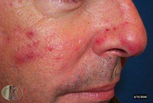 Papulopustular Rosacea