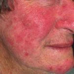 Rosacea