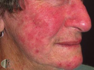 Rosacea