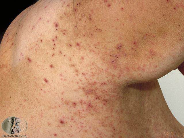 Scabies Treatment, Dermatologist