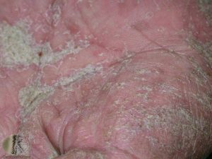 Crusted (Norwegian) Scabies