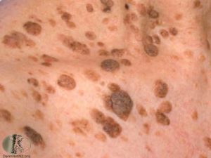 Seborrheic Keratoses - Seborrheic Keratosis