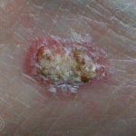 Squamous Cell Carcinoma Treatment