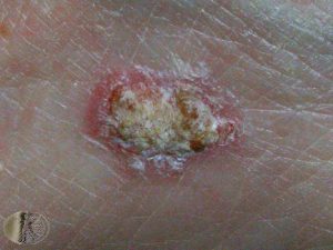 Squamous Cell Carcinoma