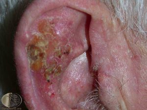 Squamous Cell Carcinoma on the Ear