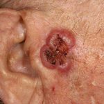 Squamous Cell Carcinoma on the Face