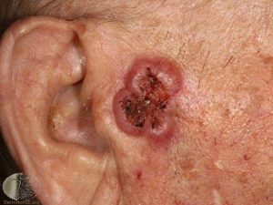 Squamous Cell Carcinoma on the Face - Skin Cancer