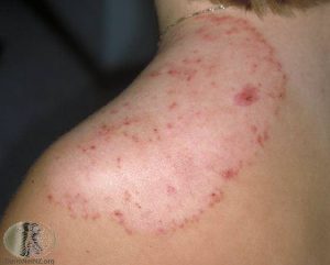 Tinea Corporis - Ringworm