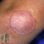 Ringworm – Tinea