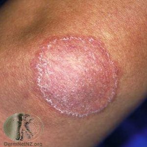 Tinea Corporis - Ringworm