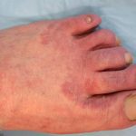 Tinea Pedis – Athlete’s Foot