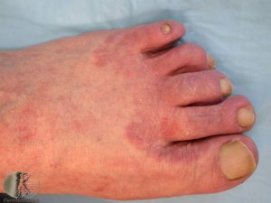 Tinea Pedis - Athlete's Foot