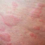 Hives (Urticaria)