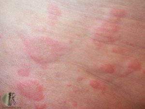 Urticaria - Hives