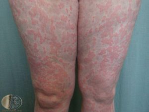 Hives on the Legs