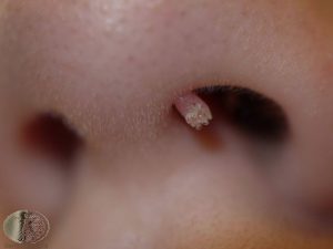 Filiform Wart in the Nose - Warts