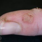Warts on a Finger