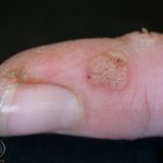 Warts