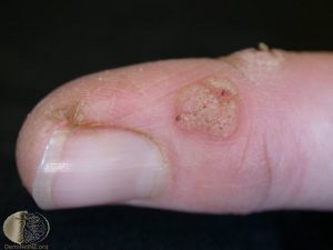 Warts on a Finger