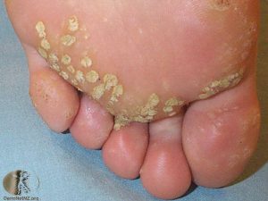 Plantar Warts