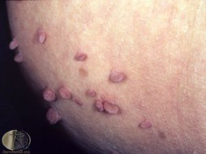 Acanthosis Nigricans Treatment