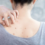 How to Get Rid of Back Acne