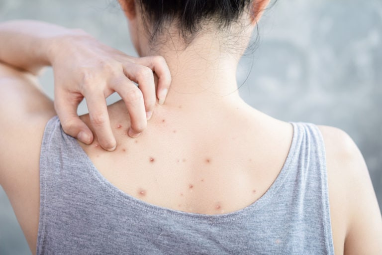 How To Get Rid Of Back Acne Body Acne Treatment